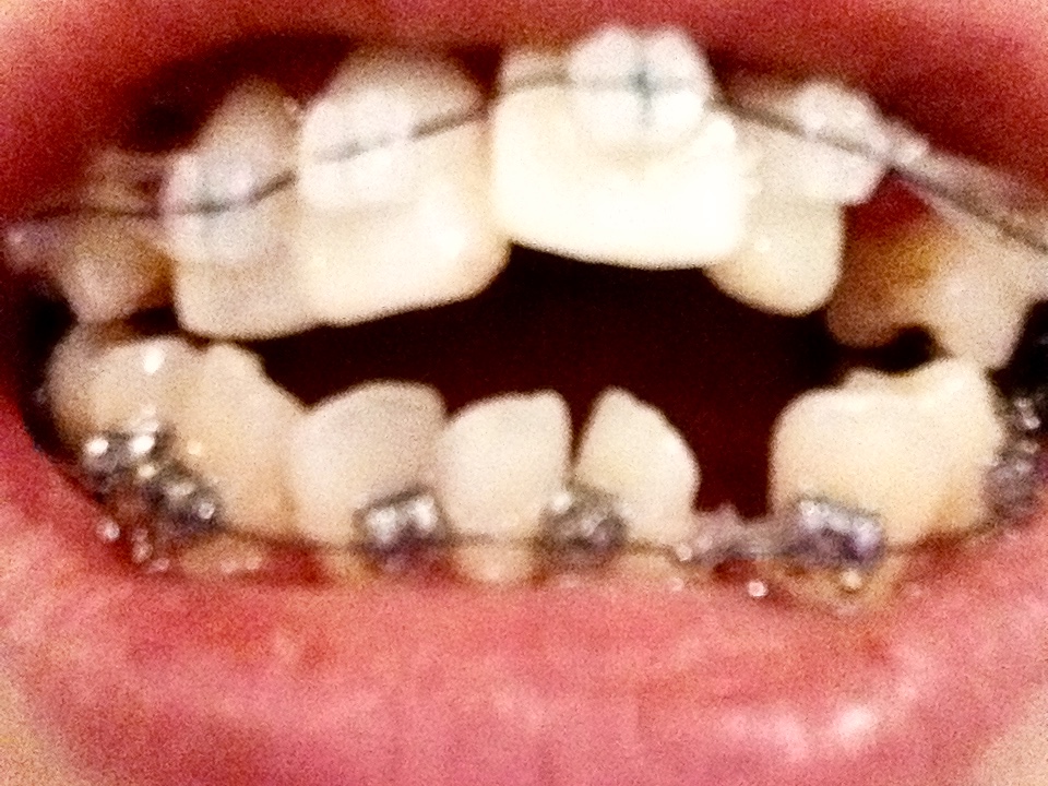 矯正 値段 列 歯